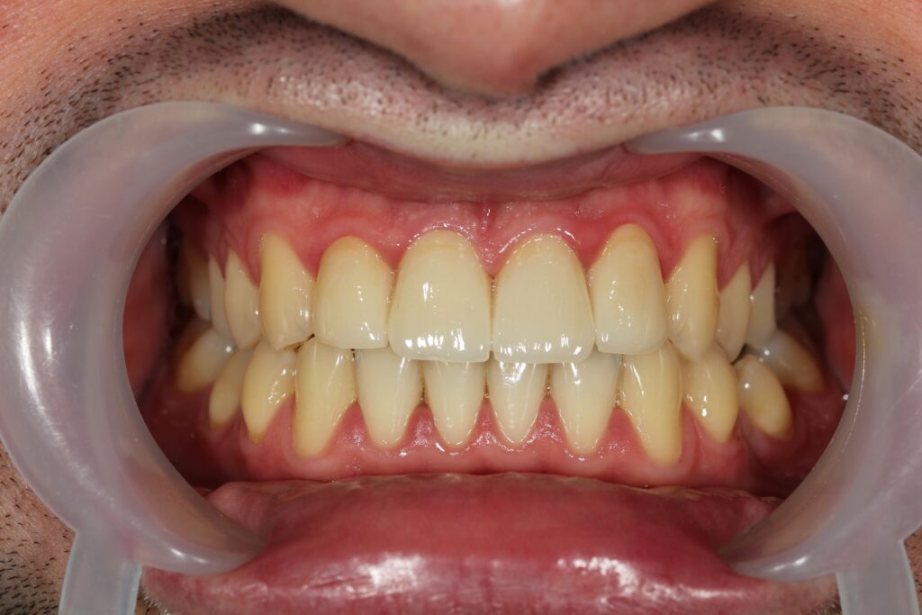 Gingivitis