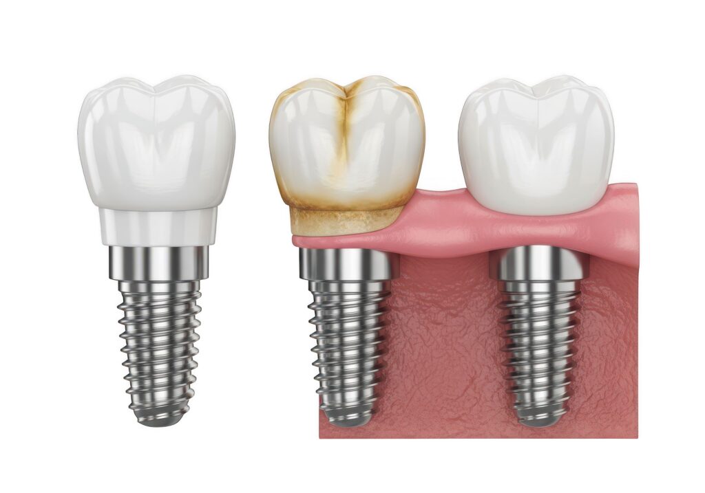 Mondzorg Eva Nazorg implantaten foto